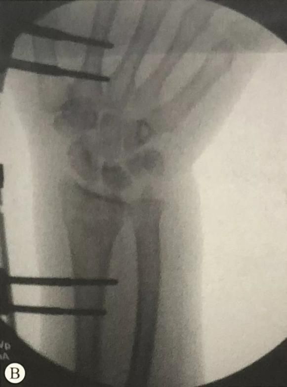 Distal Radius Fracture10