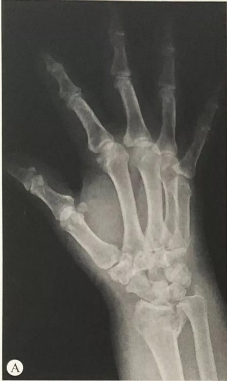 Distal Radius Fracture11