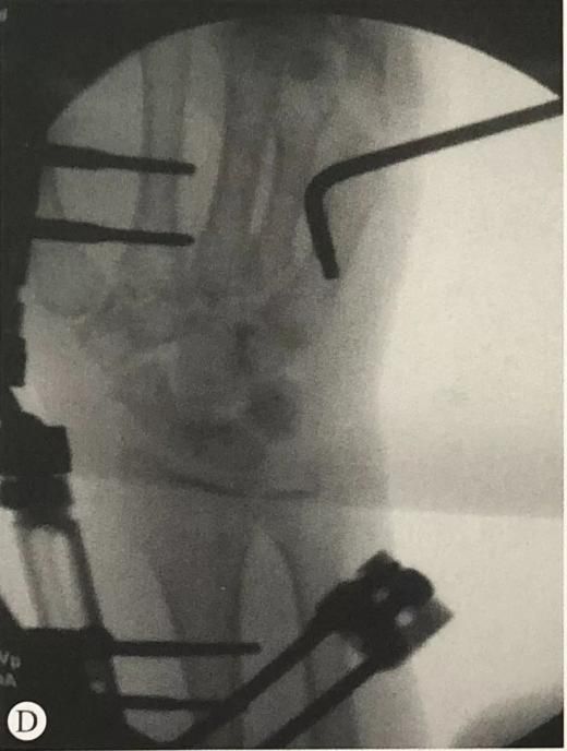 I-Distal Radius Fracture13