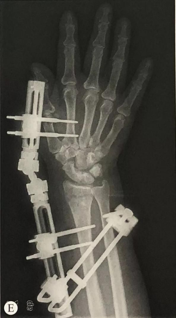 Distal Radius Fracture14