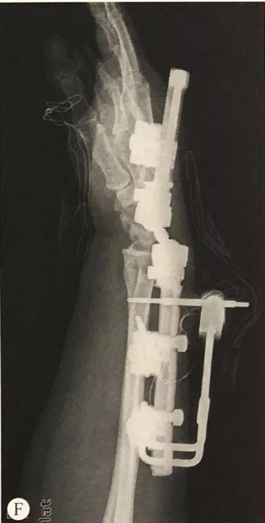 I-Distal Radius Fracture15