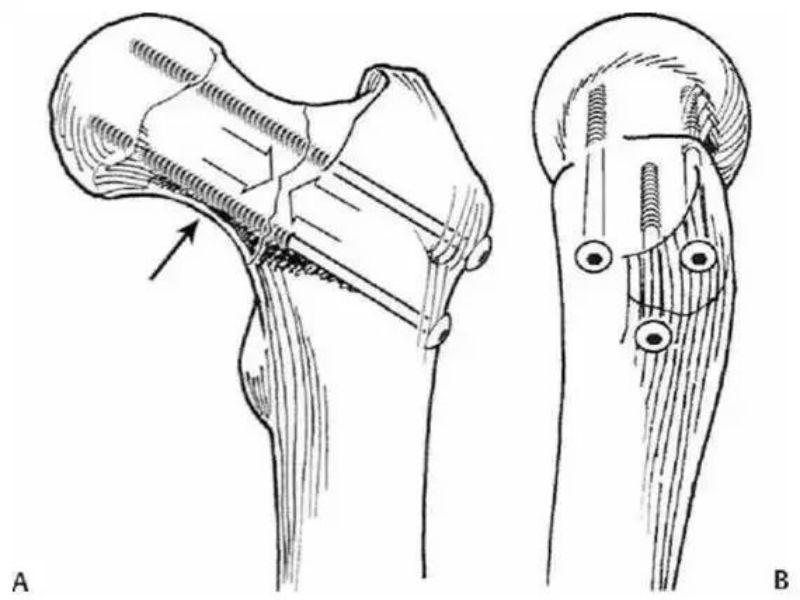 i-acvsd (5)