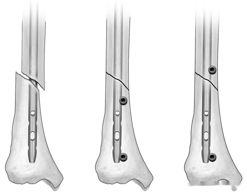 tornilyo5