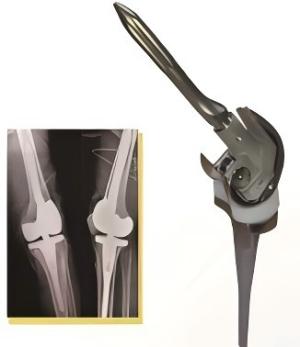 2 Hinged Knee Prosthesis Low-Cost, High-Stability Fracture Fixation Implant 1jpg