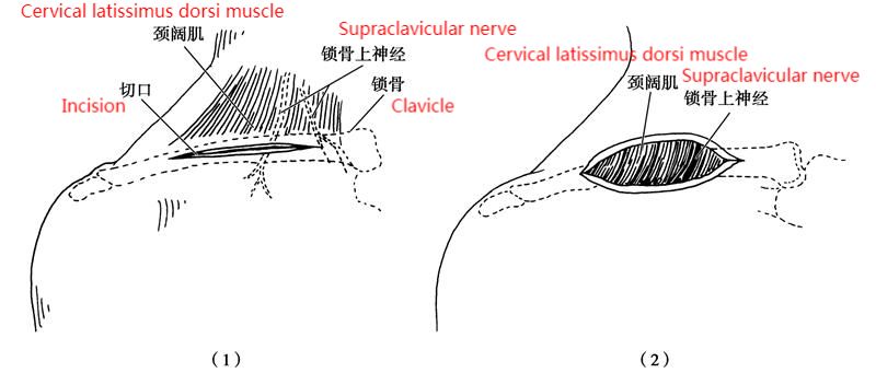 Clavicle anterior a’ nochdadh Pa1
