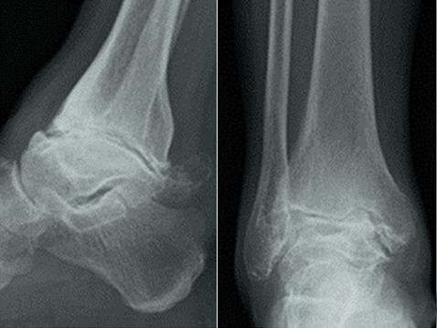 How to Do Ankle Fusion Surgery2