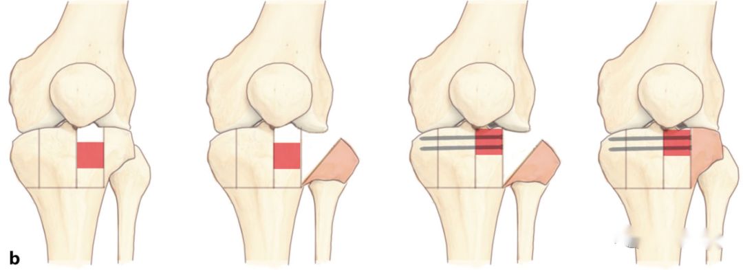 Lateral condylar osteotomy for2