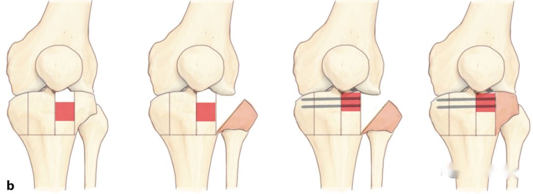 2 साठी पार्श्व कंडीलर ऑस्टियोटॉमी