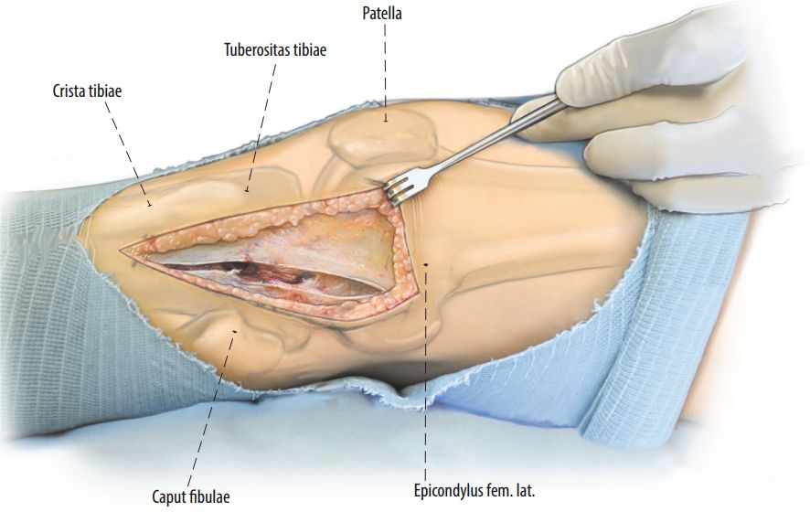 Laterale condylaire osteotomie voor4