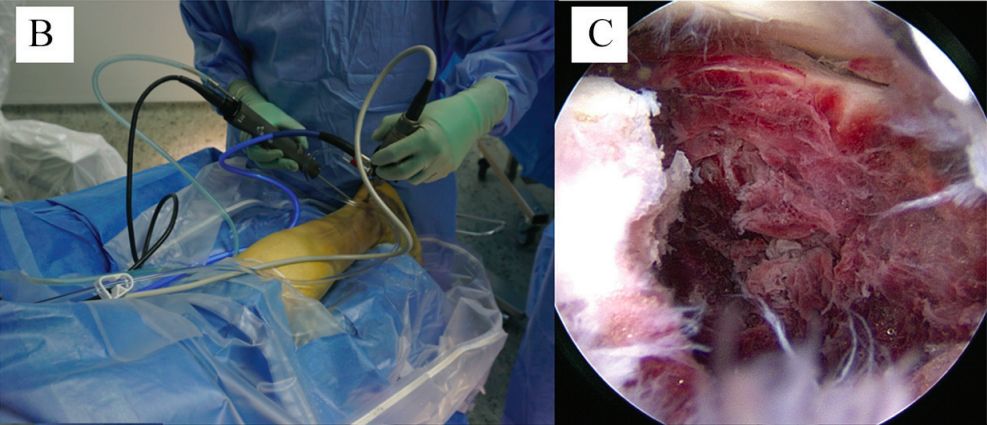 Minimally invasive treatment o11