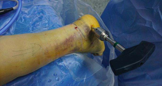 Minimally invasive treatment o12