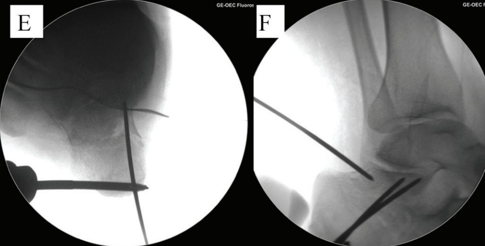 Minimally invasive treatment o13