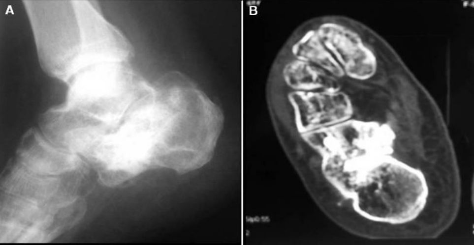 Minimally invasive treatment o18