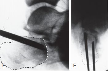 Minimally invasive treatment o4