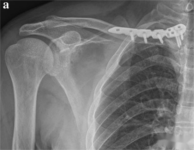 The internal fixation methods 5